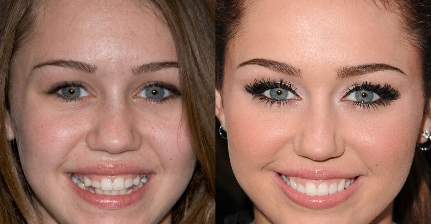 Celebrity Dental Implants Before and After6